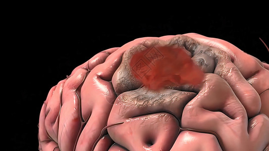 脑动脉瘤是脑血管中的膨胀或气球并发症供应流量基底障碍大脑器官状况神经系统卫生背景图片
