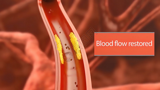 血管成形术3D动脉外科插图 内衬的动脉血管内膜有缝塞硬化 立板堆积和厚度增厚疾病生物外科药品流动生物学动脉粥样硬化导管细胞形术背景