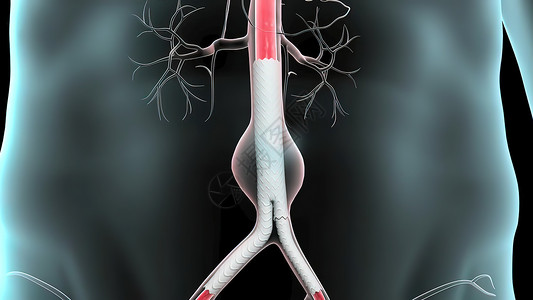 腹部动脉动脉瘤形成病人动脉心血管手术插图伤口外科主动脉疾病服务背景