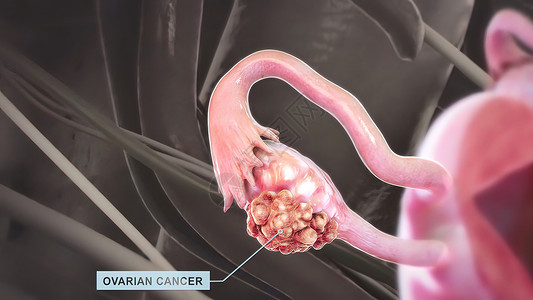 卵巢中的细胞成倍增长 并异常生长 这种疾病是脊髓癌胸部外科解剖学词云身体女士手术输卵管关心药品背景图片