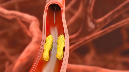 3D动脉外科插图 内衬的动脉血管内膜有缝塞硬化 立板堆积和厚度增厚科学材料治疗手术流明形术封锁生物学心脏病学疾病背景