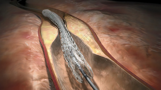支架置入术心脏病学堵塞高清图片