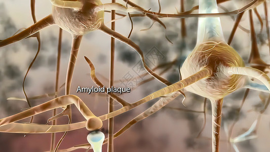 神经环路活动阿尔茨海默氏病中的乙型三维蛋白说明性蛋白网络活动树突激素电脑神经技术轴突智力颅骨背景