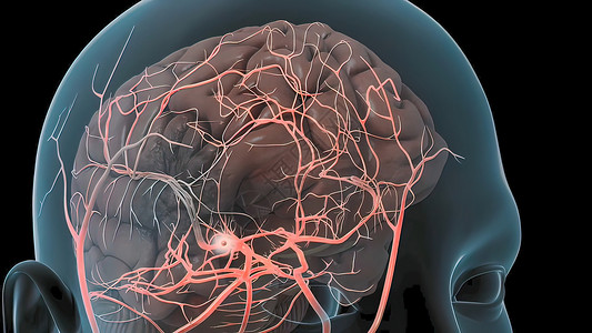 维环破裂脑动脉瘤爆发导致脑细胞出血 造成脑大出血解剖学基底系统神经系统动脉中脑高血压卫生形成疾病背景