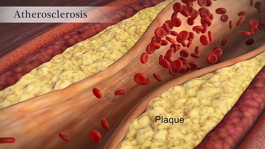 装有小板和胆固醇标志板 肥胖对健康风险概念的排布大动脉保健心血管粒子牌匾封锁红细胞疾病卫生动脉粥样硬化身体背景