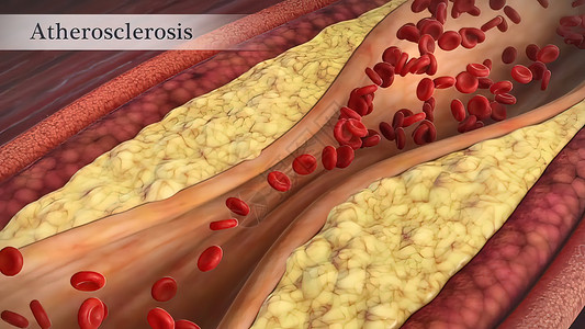 动脉硬化凝块不良高清图片