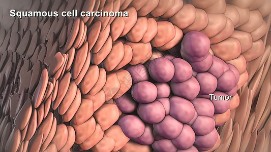 肉瘤癌症细胞的分裂和生长划分科学细胞学组织学病理染色体生活组织显微镜死亡背景