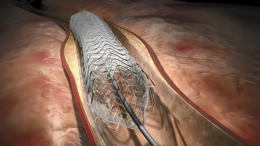 支架置入术医生卫生保健高清图片