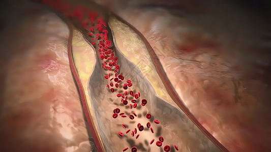 血管图3D医疗插图 其中3D型外壳可损坏血管衬内 并造成血凝块的形成压力治疗心血管程序攻击动脉粥样硬化手术器官动脉外科背景