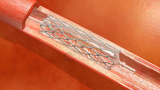 支架置入术医疗的突然的高清图片