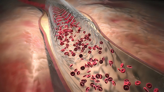 3d定妆术血红蛋白细胞流经阻塞的动脉 导致动脉硬化疾病监视器医生药品保健血管攻击医院心血管外科诊断背景