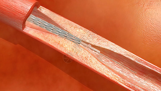 血红蛋白细胞流经阻塞的动脉 导致动脉硬化疾病监视器药品医院心绞痛医生诊断情况血管卫生攻击背景图片