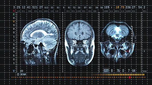 Mri扫描专业医疗设备上的脑组织图象展示身体检查断层疾病诊所考试外科癌症插图背景