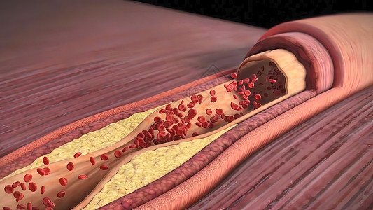 计算机辅助胆固醇斑块 神乐硬化和心脏病发作男人身体动脉粥样硬化视频科学动脉设计静脉主动脉流量背景