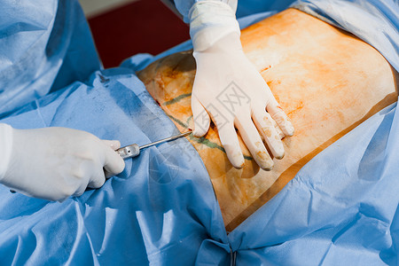 挺胸收腹外科医生给妇女做腹部生殖器瘤 在诊所进行整形手术 在医院里 可塑性手术药品女士化妆品女性橘皮病人躯干程序治疗形术背景