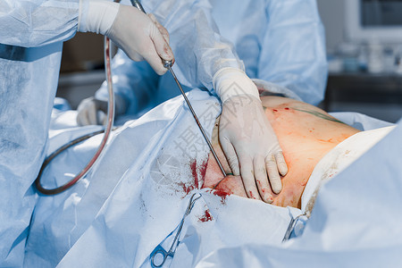 挺胸收腹外科医生给妇女做腹膜瘤 在诊所进行整形手术 在医院里 可塑性手术女性技术操作女士化妆品护士腹部躯干皮肤组织背景