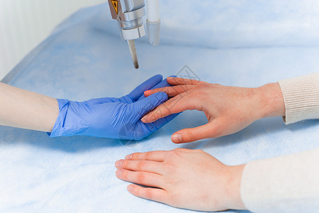 甲癣白喉病的激光治疗 在门诊部的一个年轻女孩手上感染真菌 该名女孩患有青蒿素综合症玻璃病学皮炎症状咨询考试药物疾病脚趾手指背景