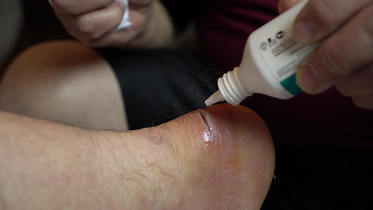 用抗消毒剂治疗腿部伤口 因炎症导致脚踝切开手术图片