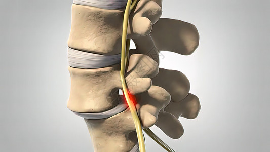 discDisc 变化和神经诱捕脊柱光盘骨头颅骨椎骨老年药品老化疼痛磁盘背景