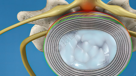 Disc 系统滑落和神经压力光盘医生骨科椎骨卫生磁盘情况药品男人插图图片