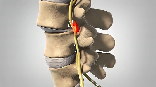 Disc 变化和神经诱捕老年卫生柱子保健状况脊椎脊柱腰椎骨头压缩背景