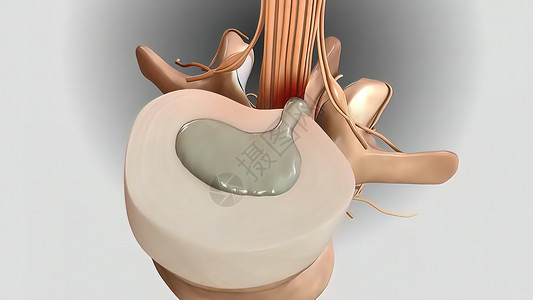 3D 销毁圆盘和压缩神经的3D示例整顿诊断扫描创伤断层腰椎放射科医生病人颈椎病背景图片