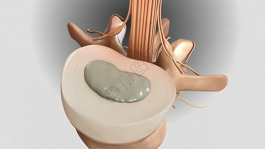 3D 销毁圆盘和压缩神经的3D示例脊柱手术医生光盘断层疾病椎骨整顿考试技术背景图片