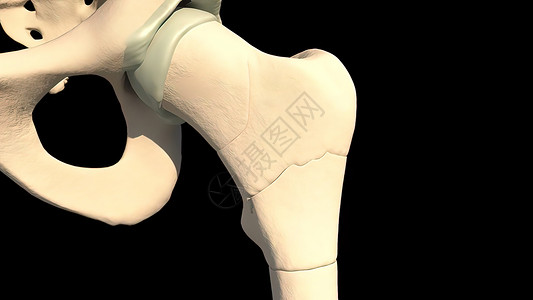 p图素材裂缝大腿骨骨折是大腿骨的断裂 裂缝或碎裂伤生理人骨骨骼髌骨科学医院形态风湿病医生保健背景
