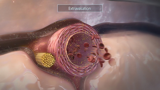 3d可视化血管外溢 液体或药物从静脉渗漏到周围组织 注 表2分裂癌细胞生活细菌免疫免疫系统治疗疾病宏观细胞背景