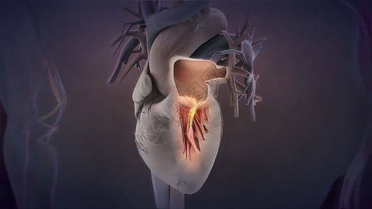 心脏性猝死3d 医疗诊断性气球药品手术疾病心脏病学导管动脉高血压插图外科背景