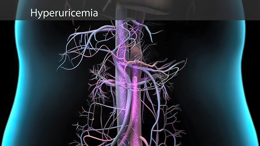 高尿酸血症3D插图科学高清图片