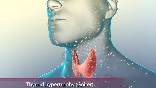 超粽意你甲状腺生成的甲状腺荷尔蒙 超过你身体需要的水平时 超正态就成为了激素生物学图表3d解剖学腹部器官癌症脖子甲亢背景