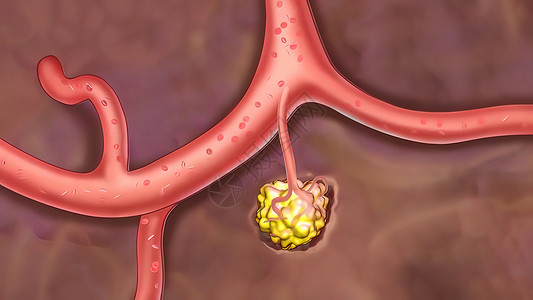 腹部可触及的结构癌症的代谢性肿瘤扩散到身体的不同部位 从那里蔓延到免疫药品生物学微生物学免疫证书病原形状绘图科学倍率背景