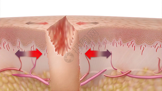 皮肤破裂3D 皮肤伤口愈合时间的医疗说明胶原改造组织静脉血管皮肤科真皮润肤图层制粒背景