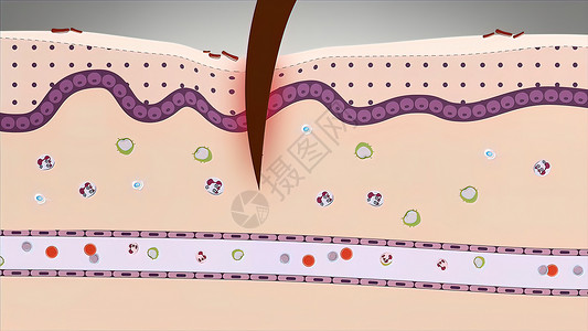 皮肤结果淋巴细胞大车高清图片