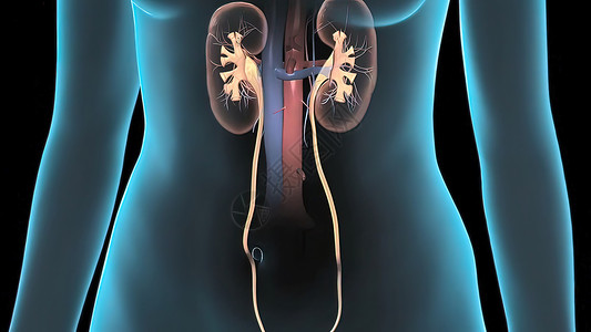 输尿管结石人类腹部面积 皮肤透明 显示肺部 胃部 直肠保健教育尿液状况肾脏身体单位疾病模拟输尿管背景