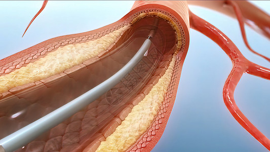 血管成形和血管干涉脂肪模拟牌匾动脉粥样硬化疾病主动脉支架流动高血压背景图片
