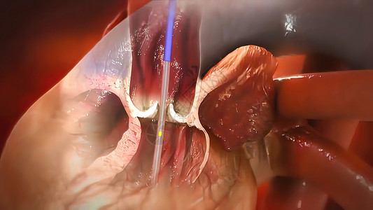 冠心血管成形术和刺塞插入动脉手术干涉支架白色治疗形术科学心脏医疗背景图片