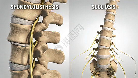 穿刺Lumbar 退化性疾病骶椎运动解剖学艺术品小路辉光女士风湿病椎骨背痛背景