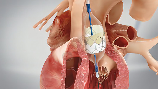 冠心血管成形术和刺塞插入导尿药品程序心脏病学支架阀门医疗插图手术形术背景图片