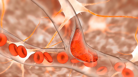 血红色的素材血栓形成静脉的高清图片