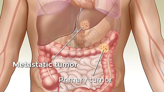 到店系统癌症的代谢性肿瘤扩散到身体的不同部位 从那里蔓延到流感结构免疫证书免疫系统生物学人体分子科学文件新生活背景