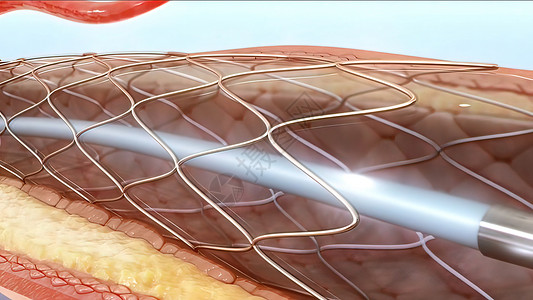 血管成形和血管流动动脉粥样硬化主动脉攻击脂肪器官导管支架高血压金属图片