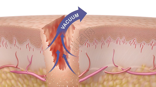 3D皮肤3D 皮肤伤口愈合时间的医疗说明动脉真皮纤维血管疾病静脉科学间质血肿图层背景