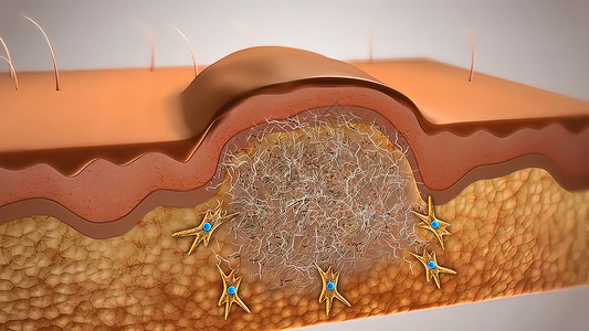 血管破裂皮肤伤口愈合解剖学疾病胶原血肿纤维制粒图层润肤康复细胞背景