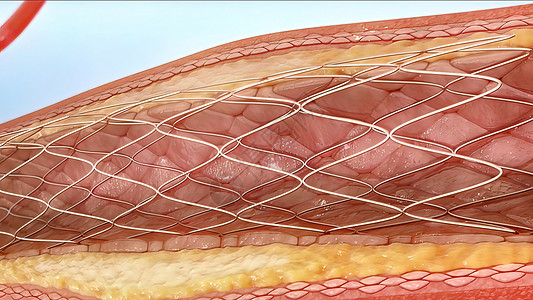 主动脉支架血管的干涉高清图片