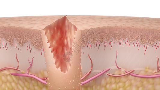 3D 皮肤伤口愈合时间的医疗说明真皮细胞康复科学插图疾病改造皮肤科血管表皮背景图片