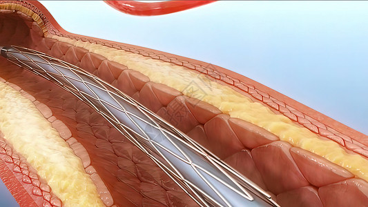 血管成形和血管外科静脉程序动脉脂肪药品攻击金属疾病气球图片