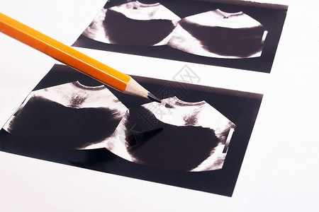超声波前列腺扫描图像图片