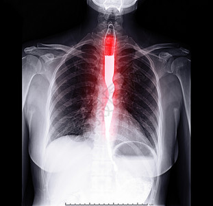 消化道溃疡食管气体疾病胃体医院小肠胃肠道大衣消化道放射科癌症背景